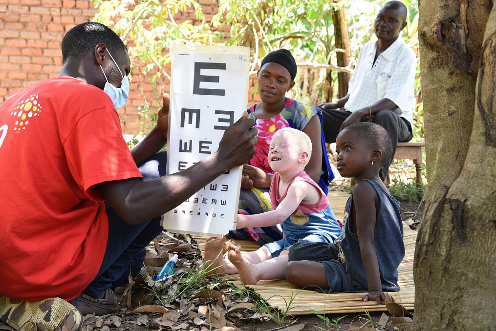 Cure oculistiche e azioni di sostegno economico: così CBM Italia opera in Uganda per i diritti delle persone con albinismo
